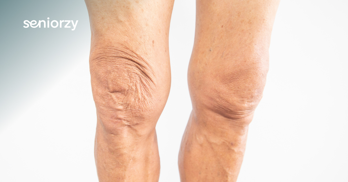Częsty problem seniorów: zimowe przesuszenie skóry nóg